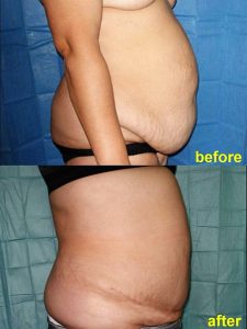 Inainte si dupa abdominoplastie pentru pacienta cu un surplus important de piele si grasime pe abdomen.
