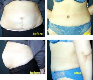 Inainte si dupa abdominoplastie pe abdomen deformat in urma unei operatii anterioare.