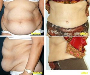 Inainte si dupa abdominoplastie combinata cu liposuctie.