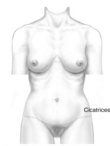 Imagine ilustrativa cicatrice dupa abdominoplastie.