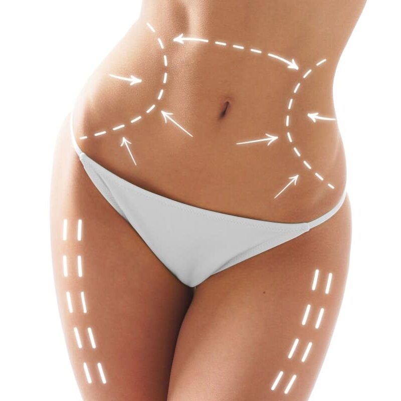 Chirurgia siluetei – Liposucție (Lipoaspirație) și abdominoplastie