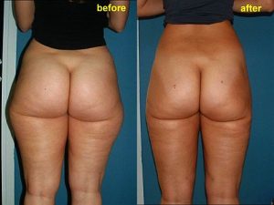 Inainte si dupa operatie estetica de liposuctie la nivelul coapselor si feselor.