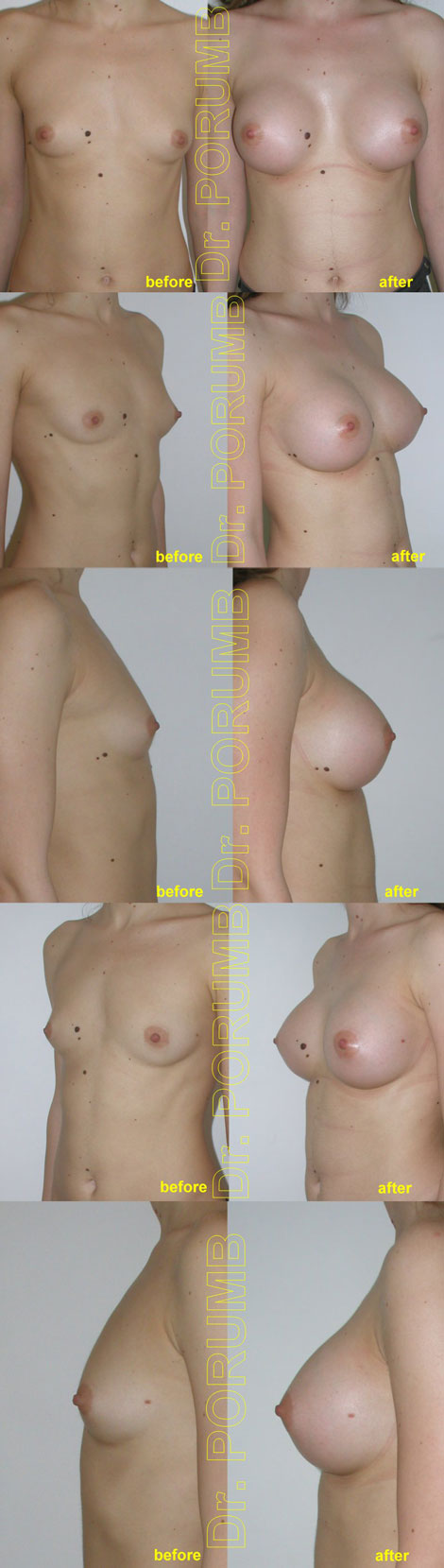Pacienta de 24 ani, doreste sa apeleze la interventia de augmentare mamara pentru o operatie estetica de marire de sani (silicoane), pentru apropiere sani, mai buna simetrizare, dar si obtinerea unor sani armoniosi, naturali