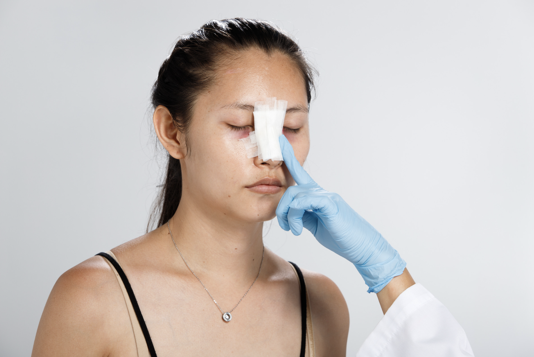 Îngrijire postoperatorie după rinoplastie, cu pansament nazal, ilustrând faza de recuperare după operația de remodelare a nasului