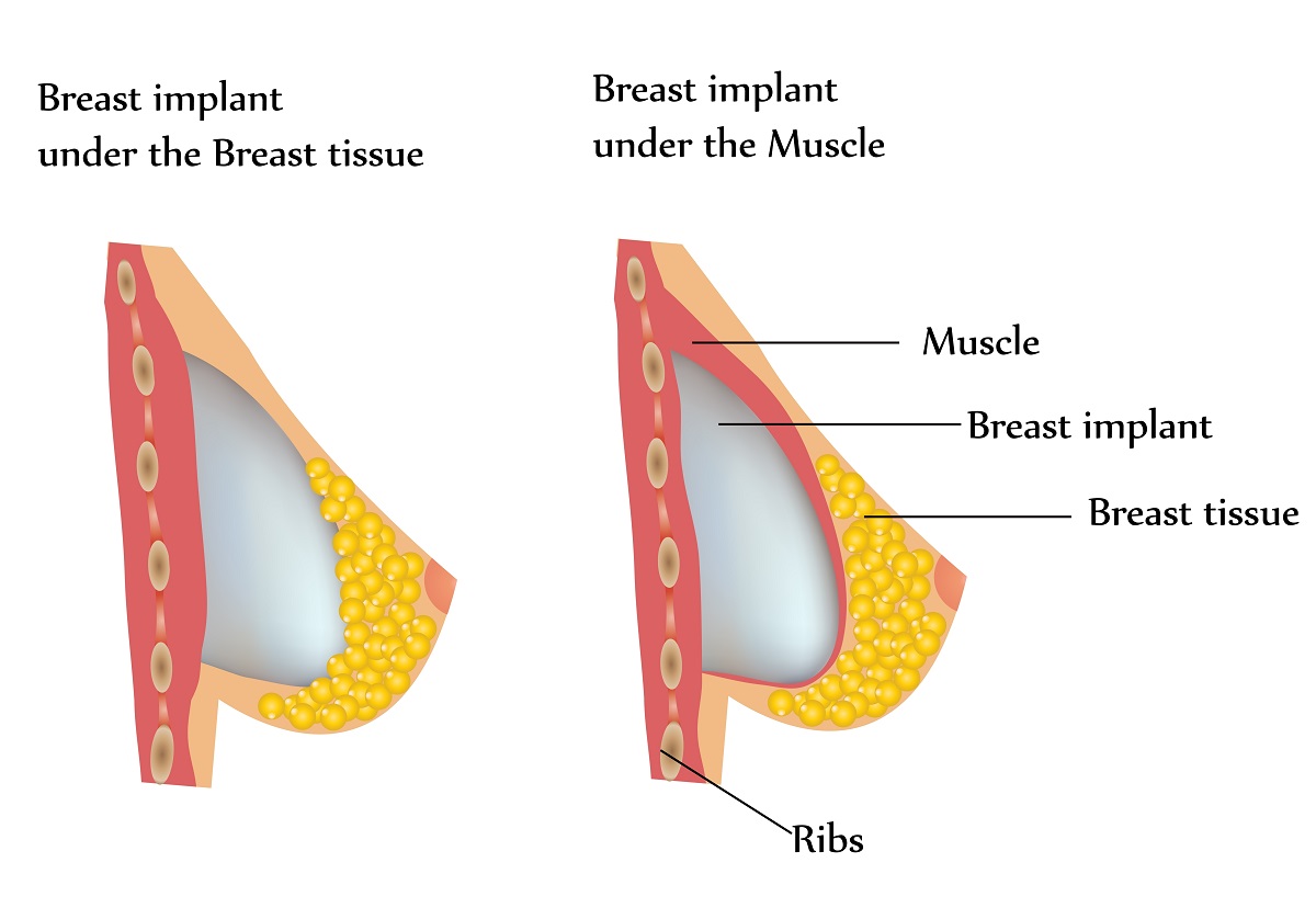 Diferențe între implant mamar sub țesutul mamar și sub mușchi, schemă explicativă