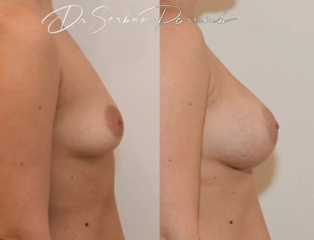 Pacienta inainte si dupa interventie de marire a sanilor cu implant anatomic.