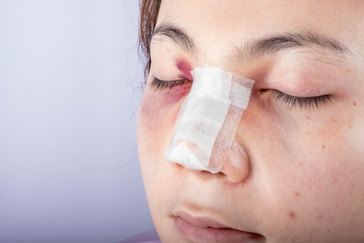Tânără cu bandaj pe nas și vânătăi după o rinoplastie.
