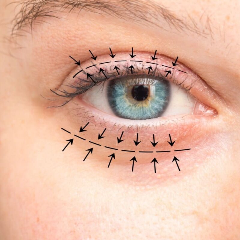 Blefaroplastie – Operație pentru pleoapele căzute