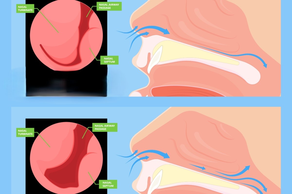 Imagine ilustrativa hipertrofie cornete nazale vs cornete nazale normale