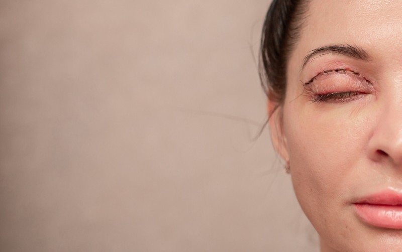Femeie care a optat pentru o blefaroplastie