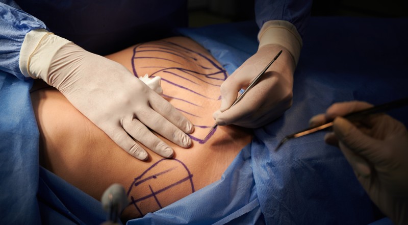 Operatie de abdominoplastie